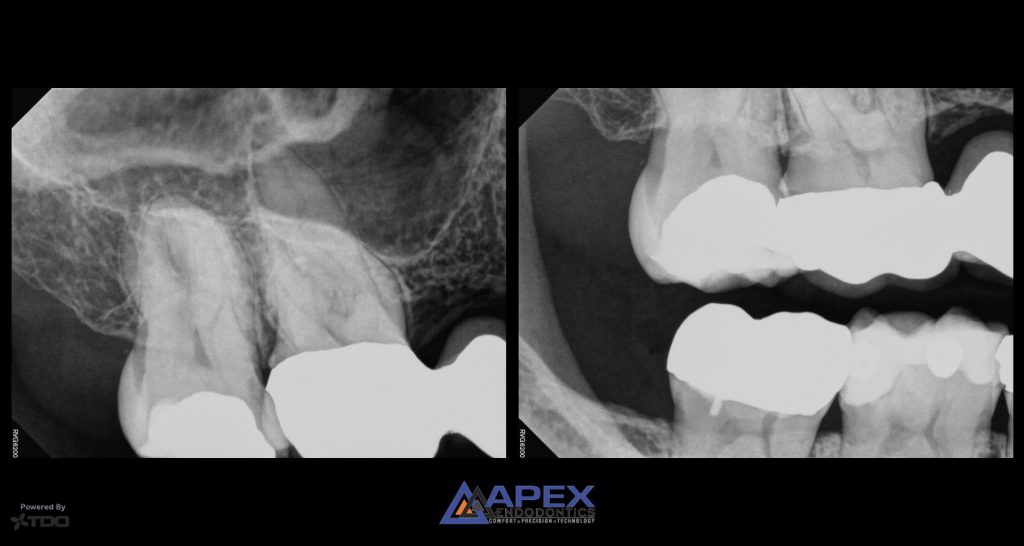tooth sensitivity to heat