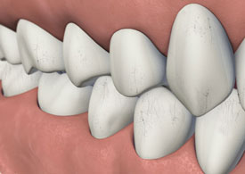 What Are Teeth Craze Lines? Treatment, Causes & Prevention - Tooth