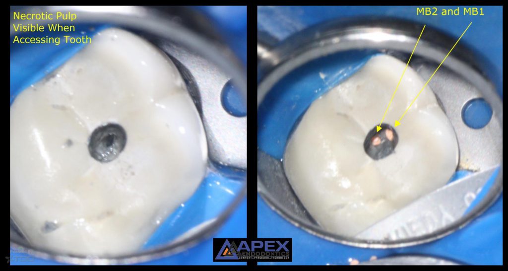 Before and after endodontic treatment