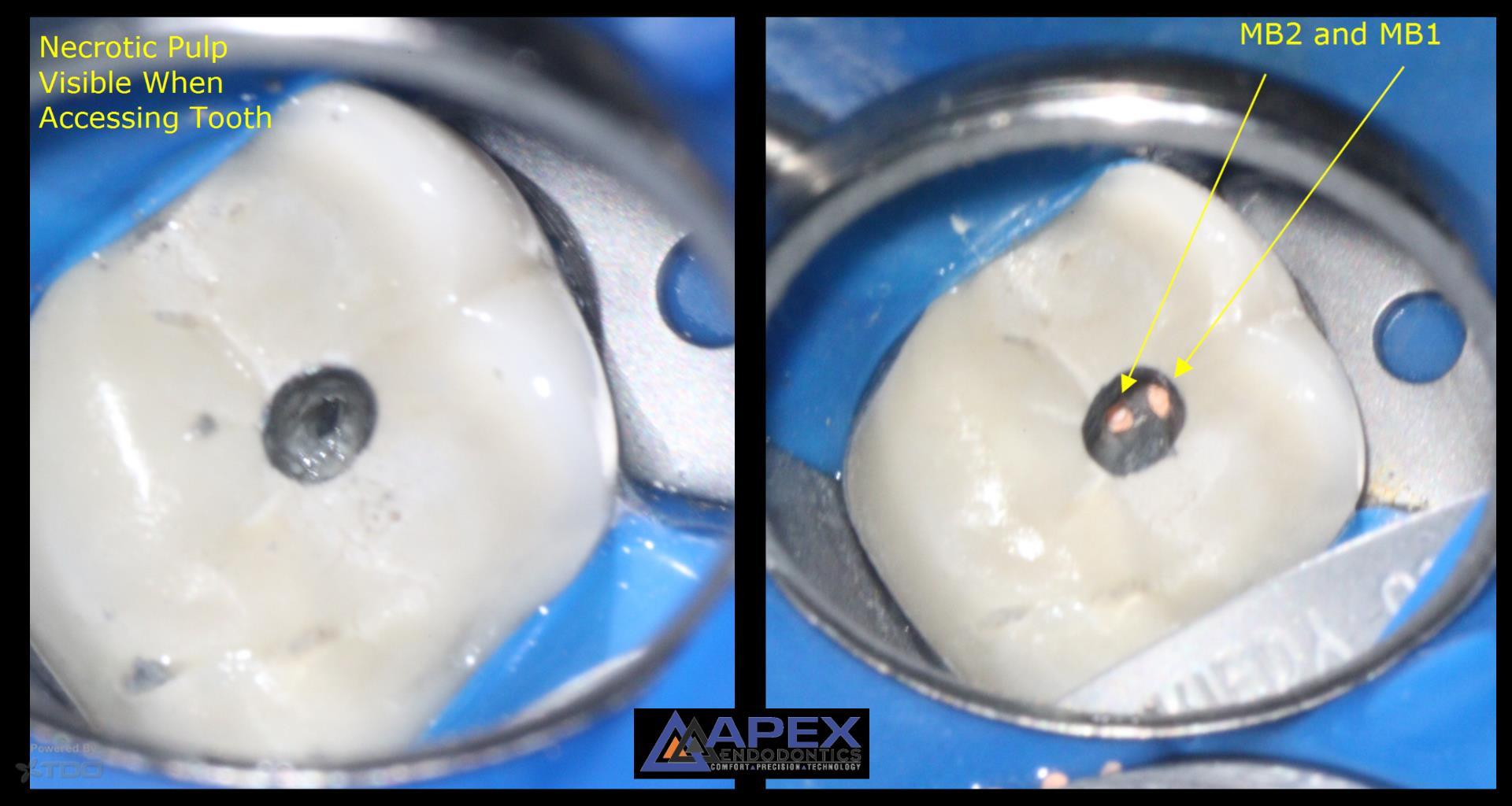 Case Study Cracking The Case of Tooth Sensitivity to Heat in Tooth 3