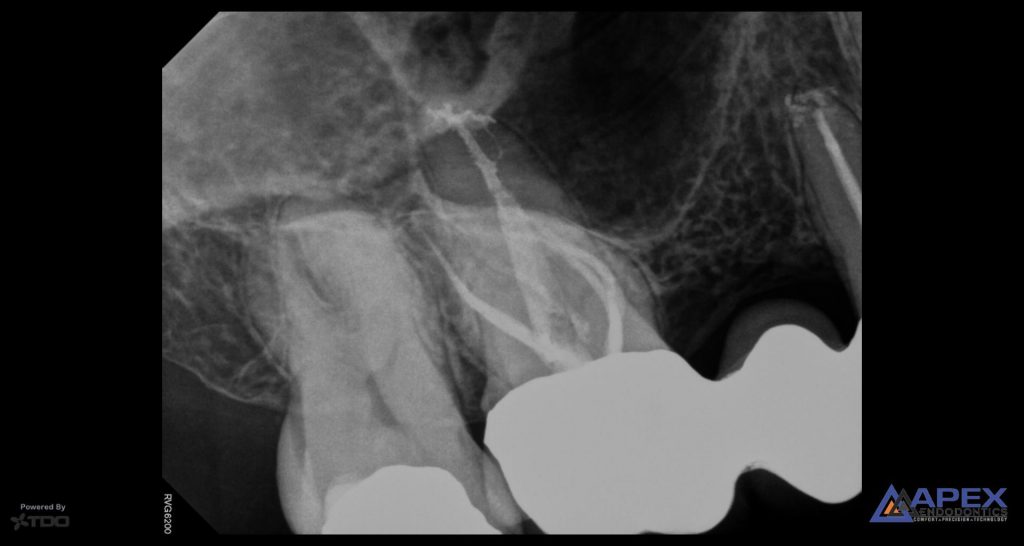 endodontic treatment